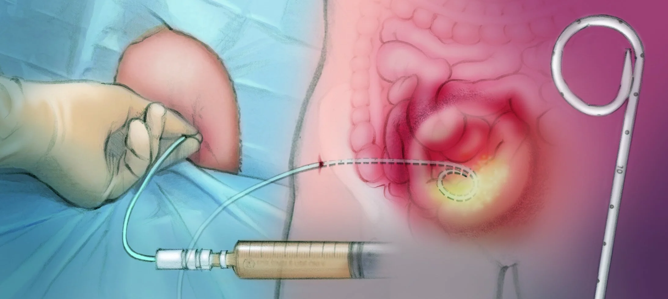 Abscess & Fluid Drainage