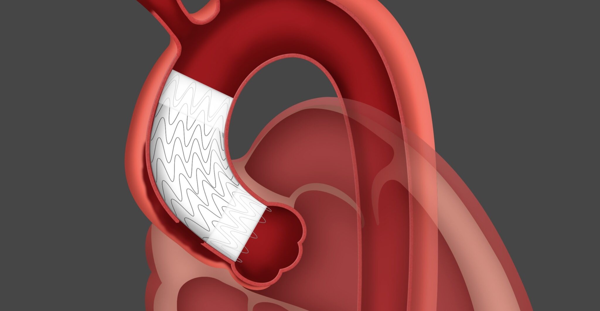 Aortic Stent Grafting