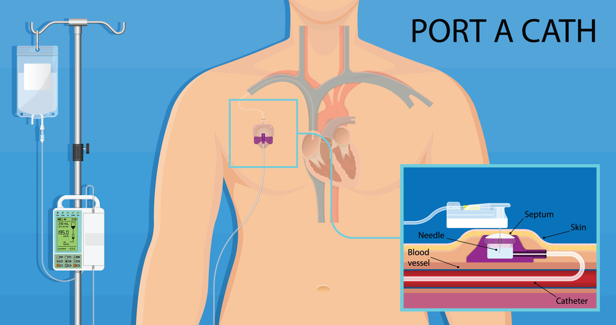 Oncology Vascular Access Ports