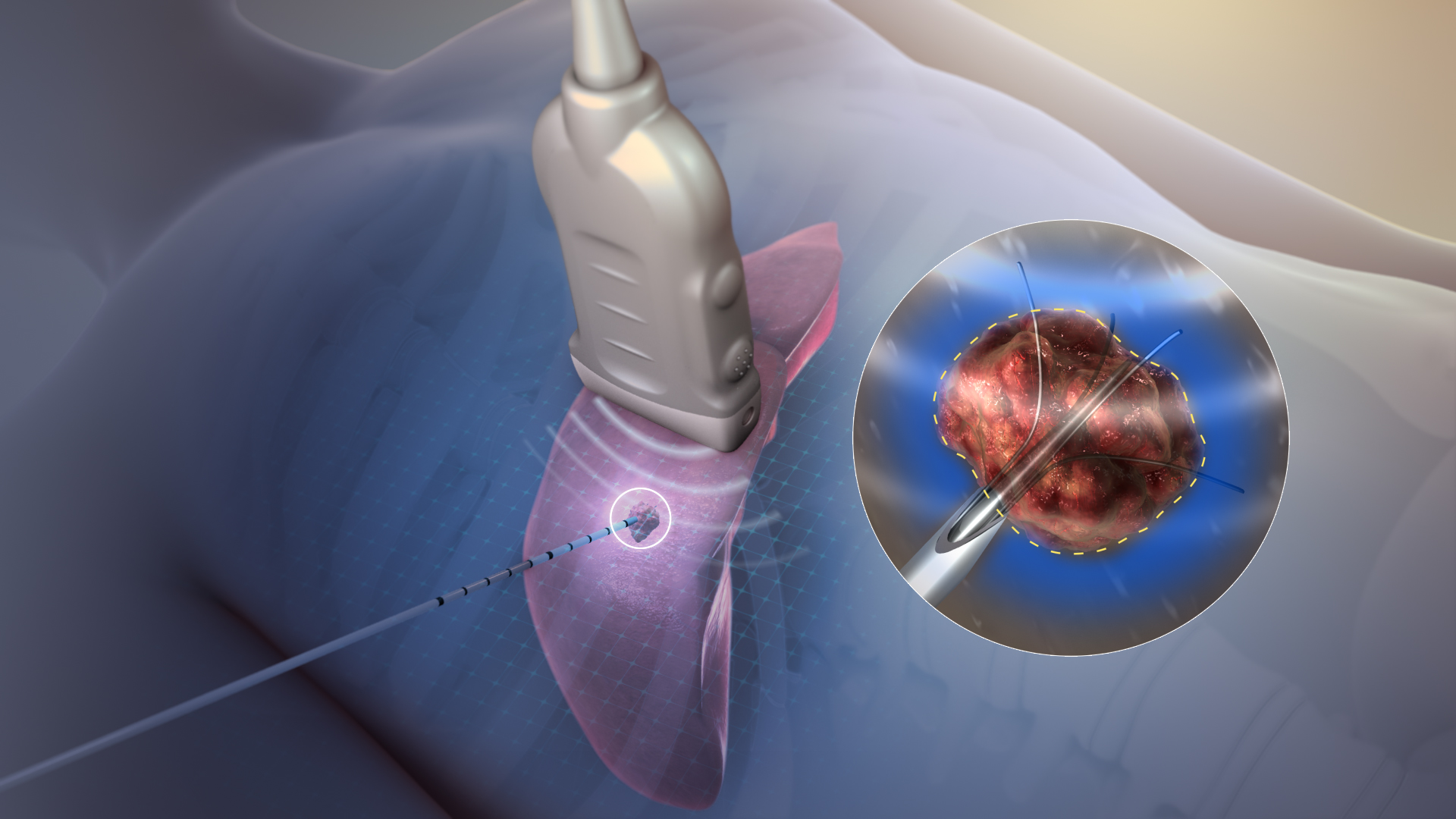 Radiofrequency / Microwave Ablation